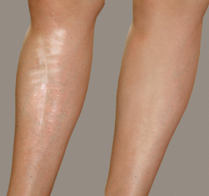 corpus christi scar removal