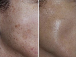 treat hyperpigmentation