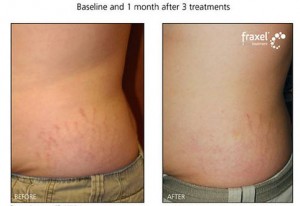 reduce stretch marks corpus christi