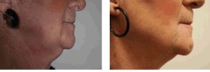 Non-invasive neck lift Corpus Christi