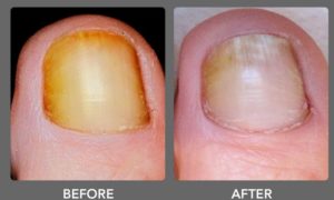 laser toenail fungus removal