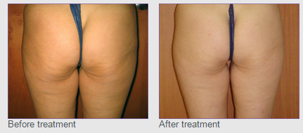 endymed cellulite before and after