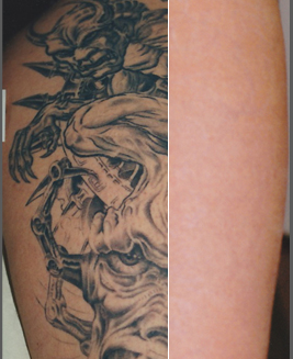 Laser Tattoo Removal Victoria TX Archives -