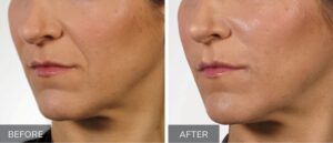 BeforeAndAfter VERSA™ Dermal filler in victoria texas