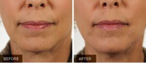 BeforeAndAfter VERSA™ Dermal filler in victoria texas