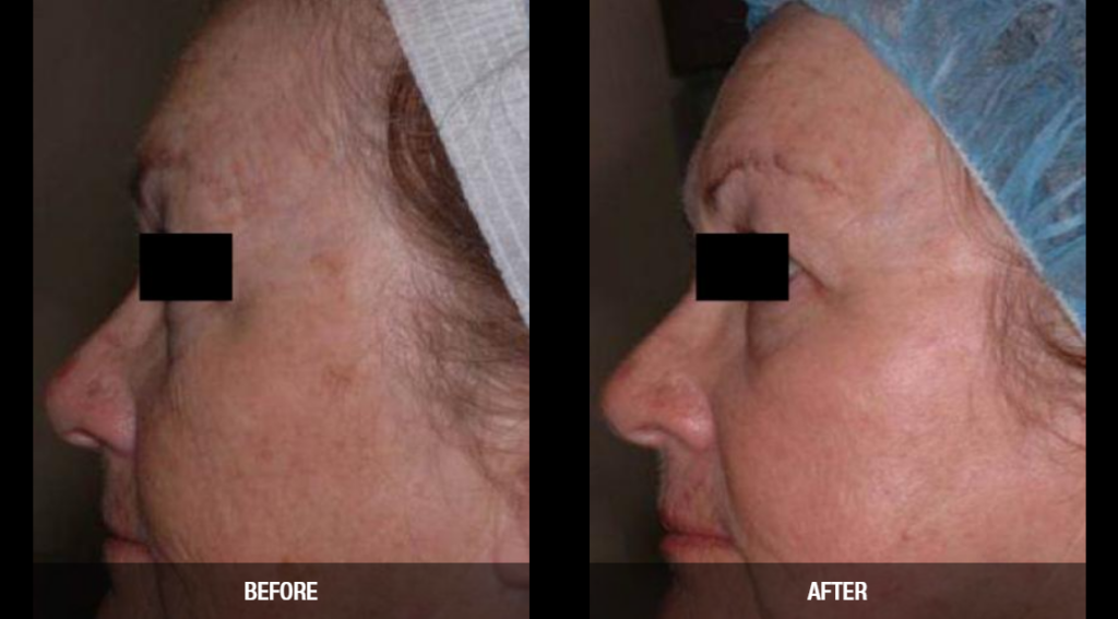 CO2 laser resurfacing victoria texas 1