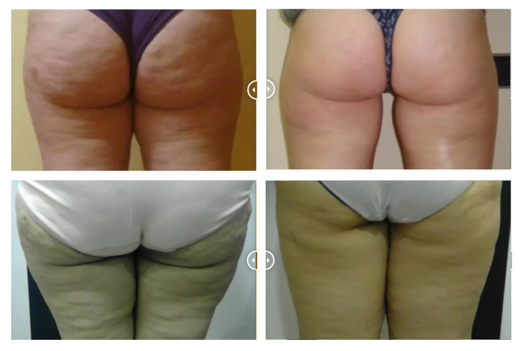 Cellulite Treatment in Texas 