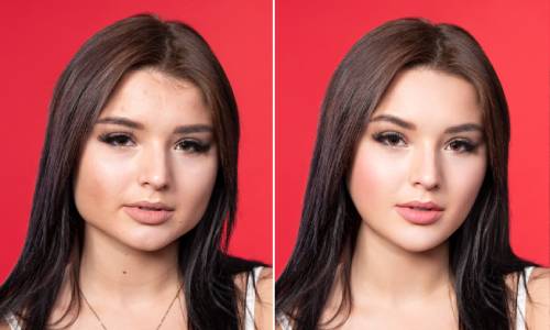 JUVEDERM2