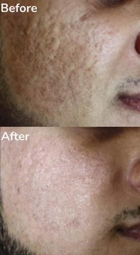 CO2 Fractional Laser Resurfacing Treatment