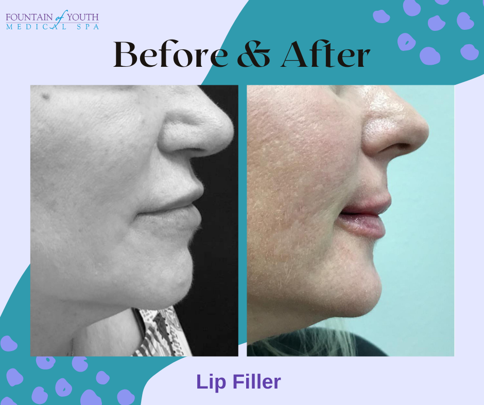 lip fillers in Victoria, texas