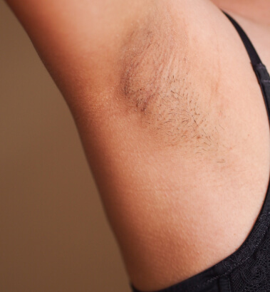 Before and After - Laser Hair Removal