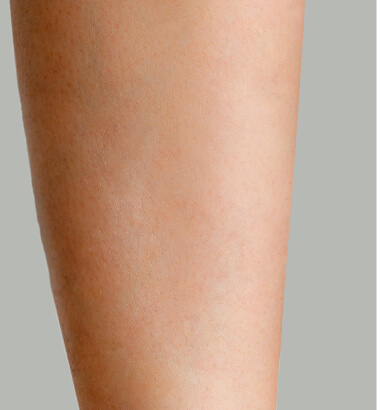 before-after-body-hair-removal-2-b