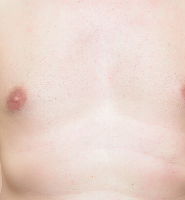 before-after-body-hair-removal-3-b