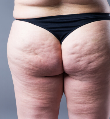 before-after-bootylift-1-a