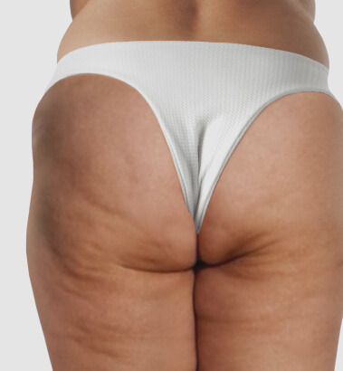 before-after-bootylift-3-a