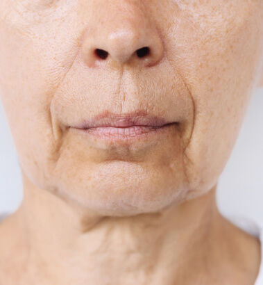 Before and After Juvederm