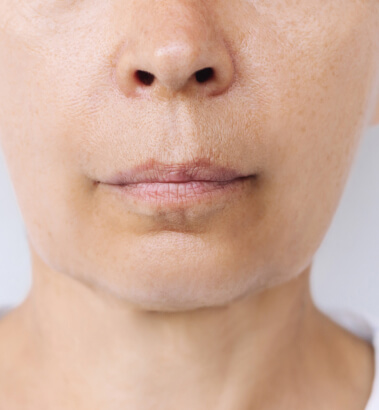 Before and After Juvederm