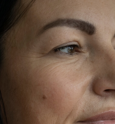 Before and After Juvederm