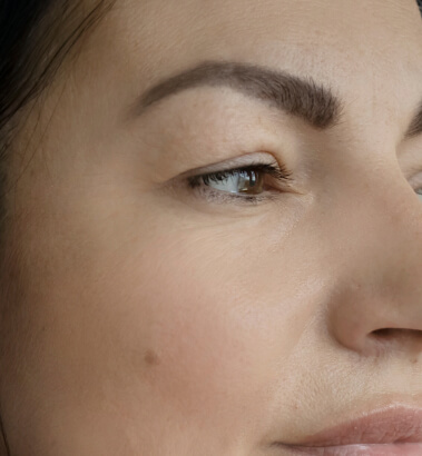 Before and After Juvederm