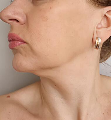 before-after-kybella-1-a Before and After Kybella