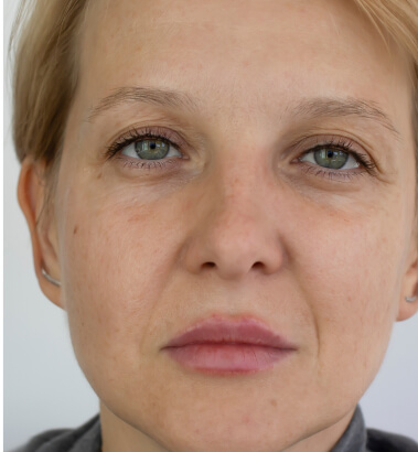 before-after-rf-microneedling-1-a RF Microneedling