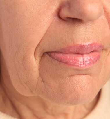 before-after-sofwave-3-a before-after-sofwave-3-a