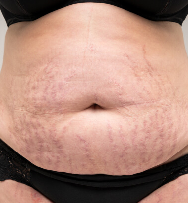 Before After Stretch Marks