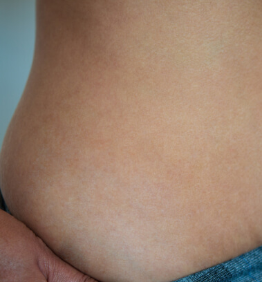 before-after-stretch-marks-3-b