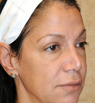 before-after-ylift-1-a Before After Ylift