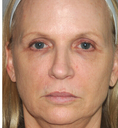 before-after-ylift-13-a before-after-ylift-13-a