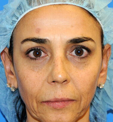 before-after-ylift-6-a Before After Ylift