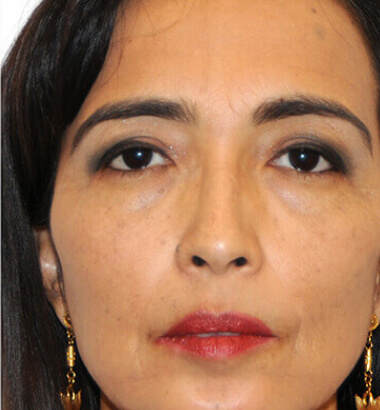 before-after-ylift-8-b