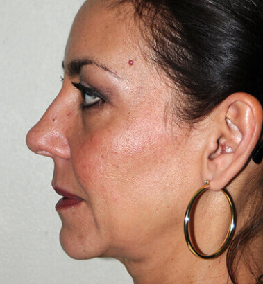 before-after-ylift-9-a before-after-ylift-9-a