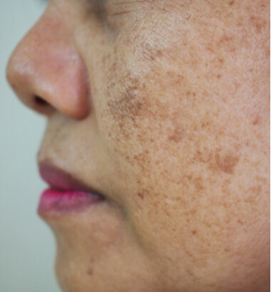 before-after-PRX-1-a Before and After