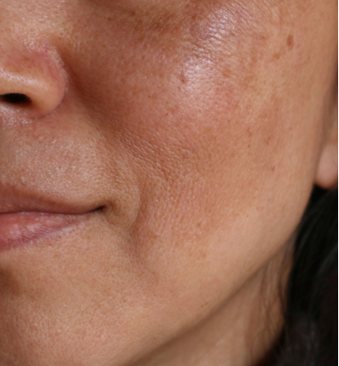 before-after-prf-1-b