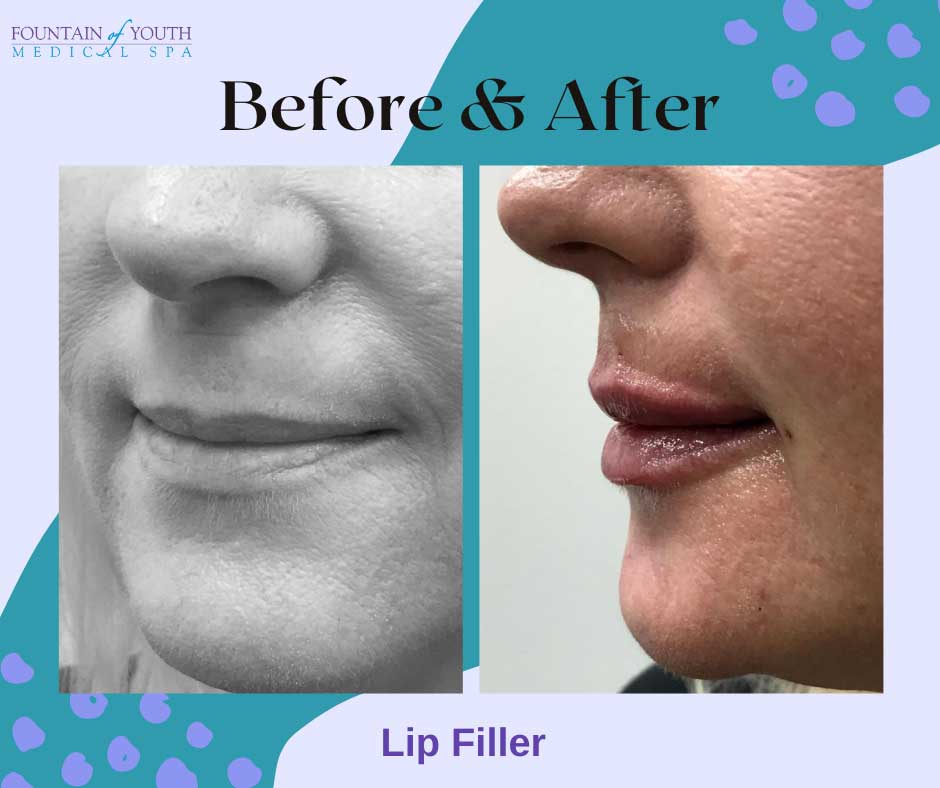lip injections in Victoria, Texas