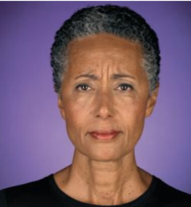 Before Image: Botox - front