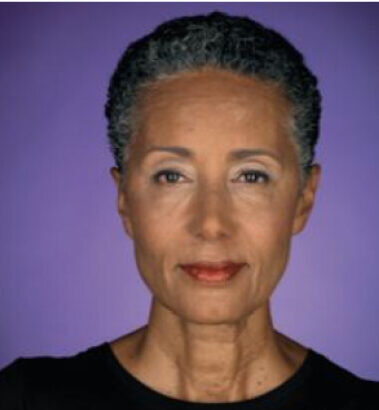After Image: Botox - front