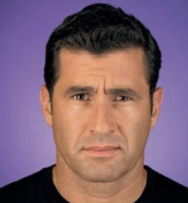 Before Image: Botox - front