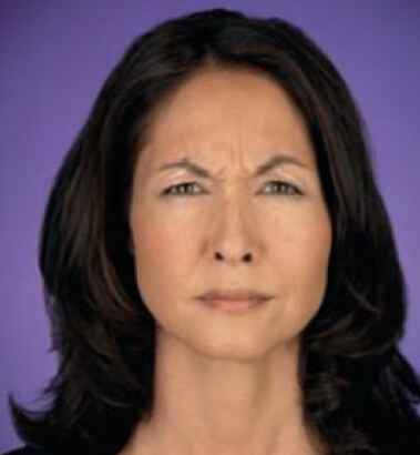 Before Image: Botox - front