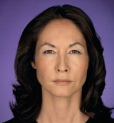 After Image: Botox - front