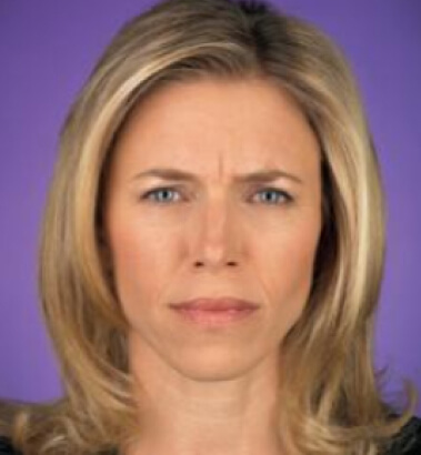 Before Image: Botox - front