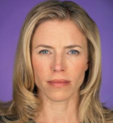 After Image: Botox - front