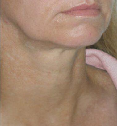 Before Image: Thread Lift - right-front-oblique