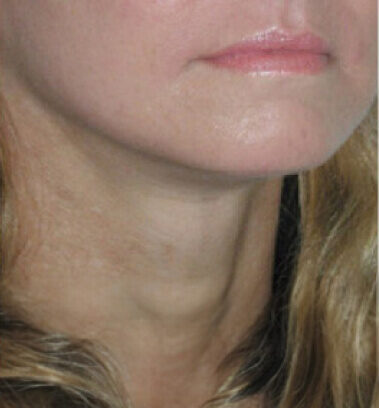 After Image: Thread Lift - right-front-oblique
