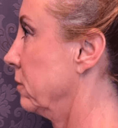 Before Image: Thread Lift - left-side