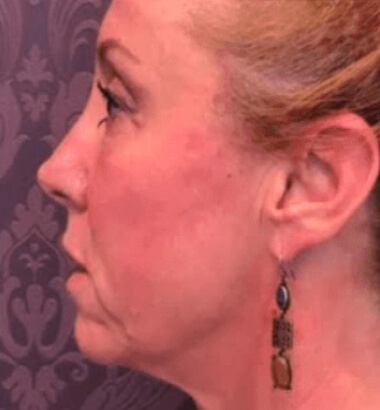 After Image: Thread Lift - left-side