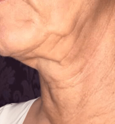 Before Image: Thread Lift - left-front-oblique