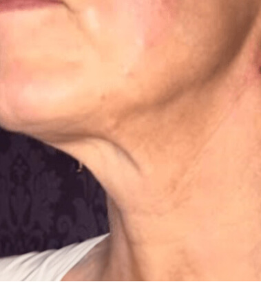 After Image: Thread Lift - left-front-oblique