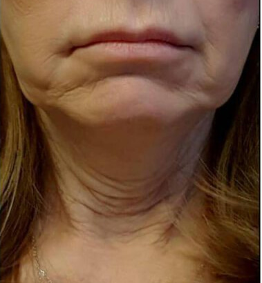 Before Image: Thread Lift - front